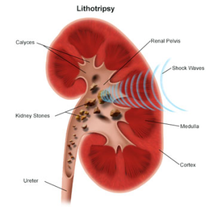 Image of Kidney during Lithotripsy